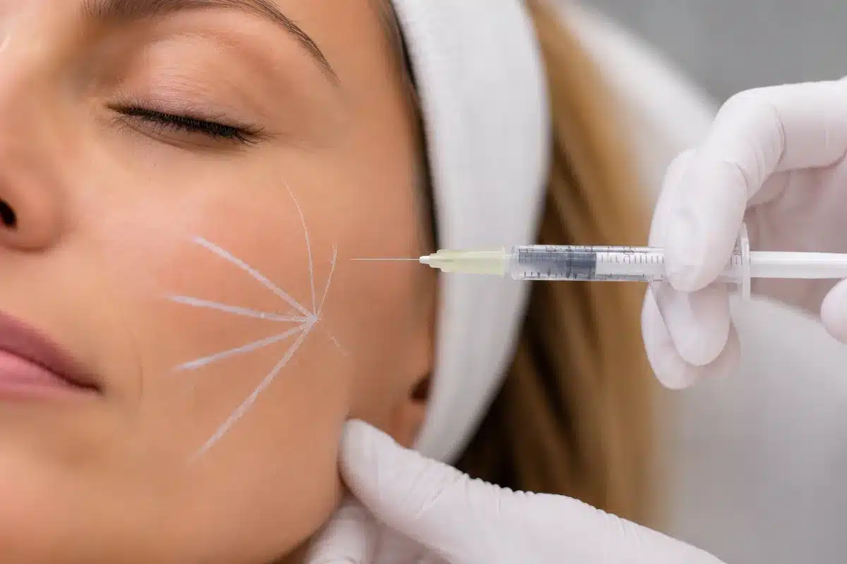 Sesión de cicatrices de acné en SkinAtelier