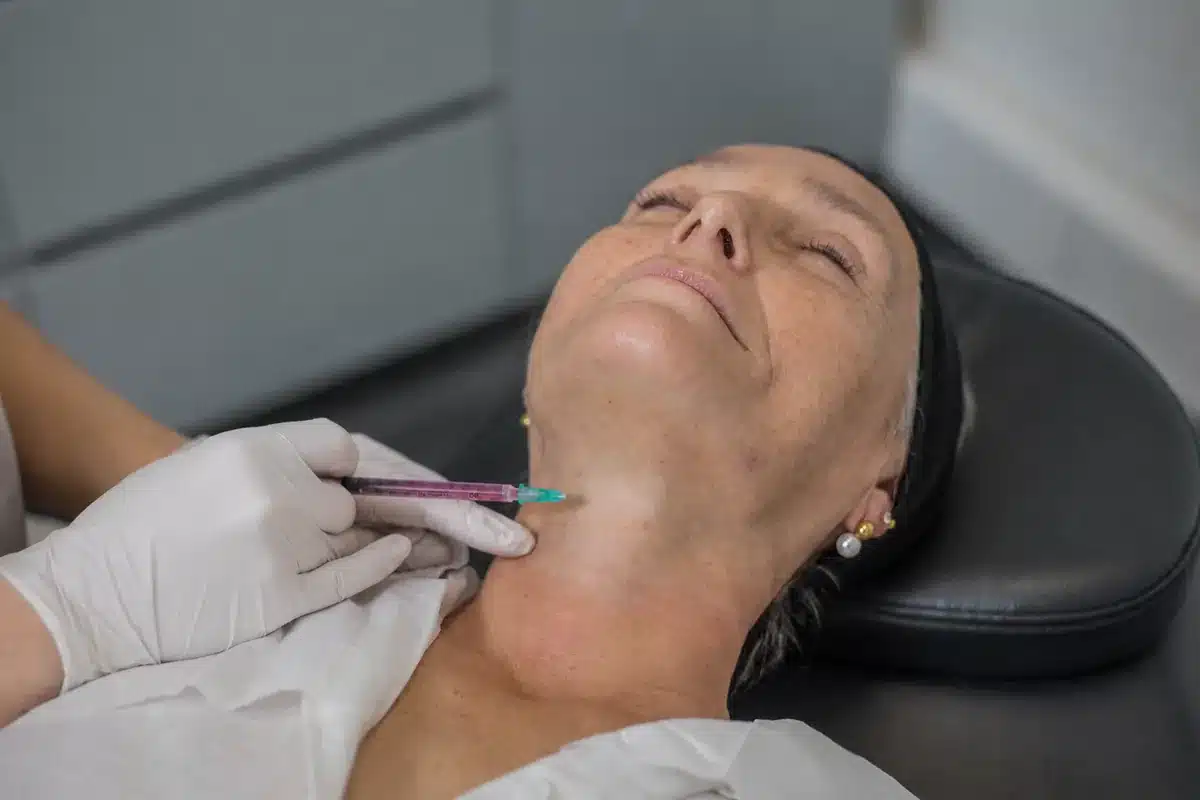 Cicatrices de acné en SkinAtelier, Las Condes