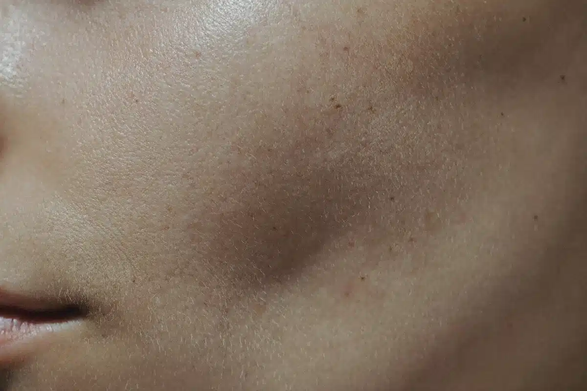 Sesión de microneedling en SkinAtelier